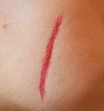 Blessure